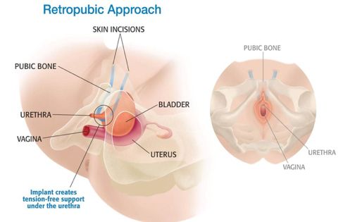 Surgery For Female Stress Urinary Incontinence - Urology Waikato